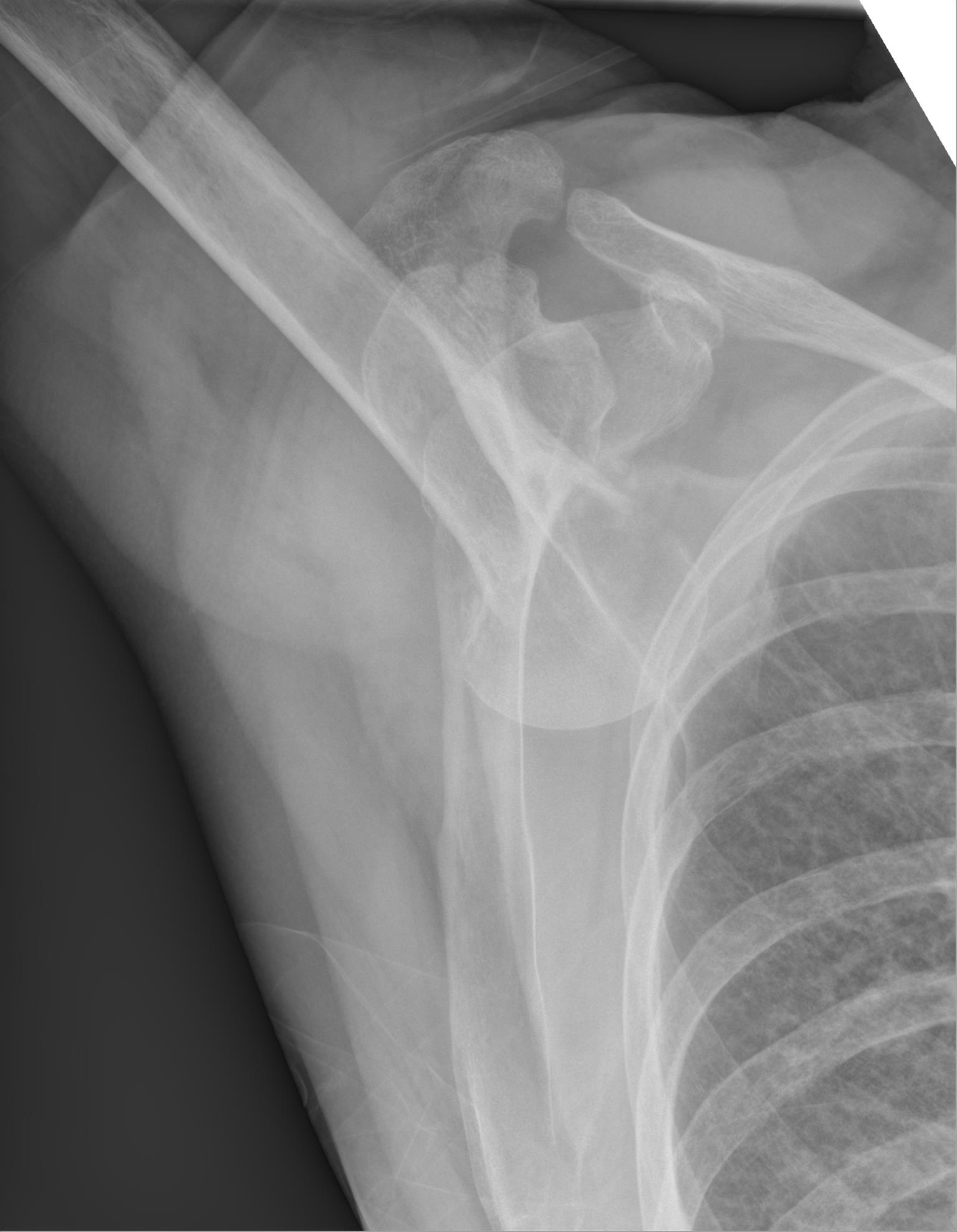 Radiograph of luxatio erecta, an inferior shoulder dislocation with the humeral shaft pointing upward and the humeral head below the glenoid