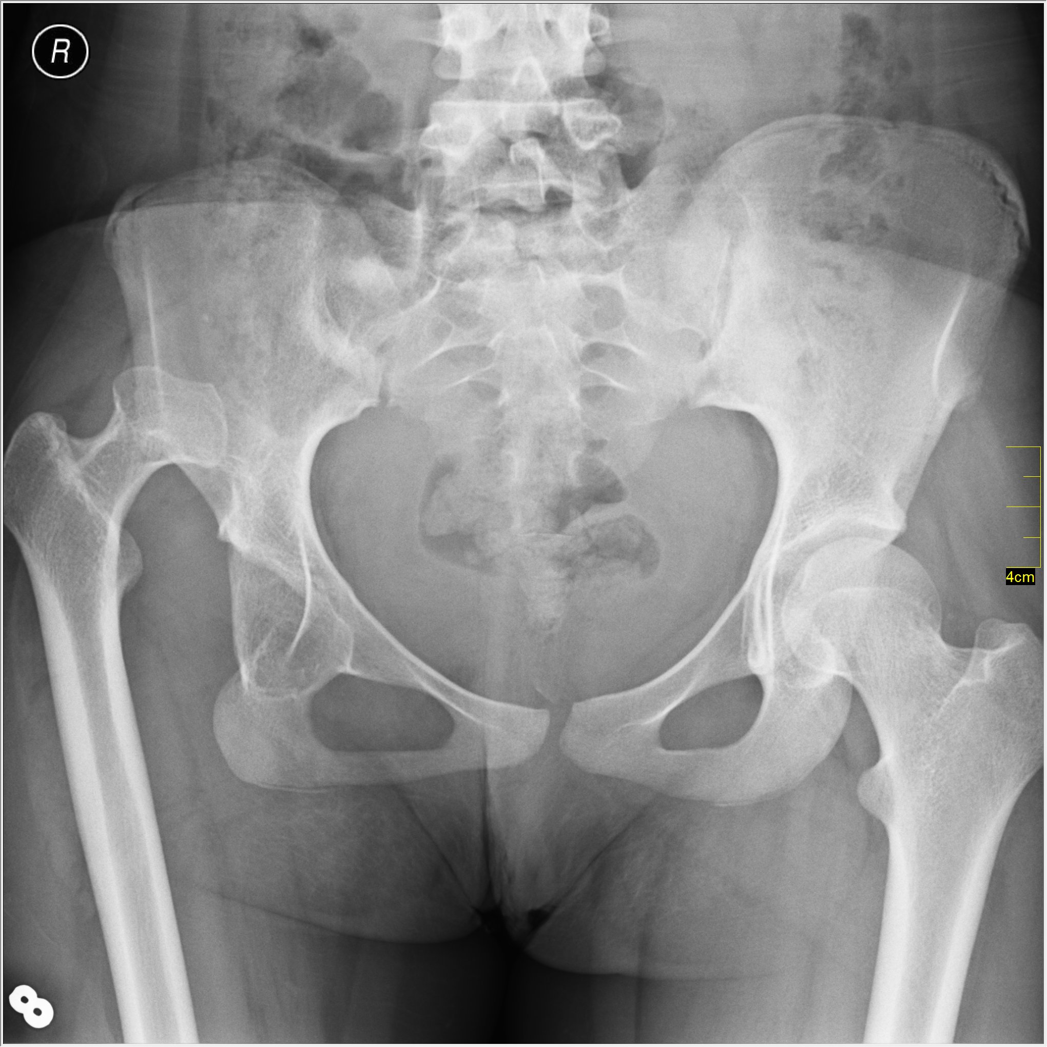 Anteroposterior pelvis radiograph showing a native left posterior hip dislocation with the femoral head displaced out of the acetabulum