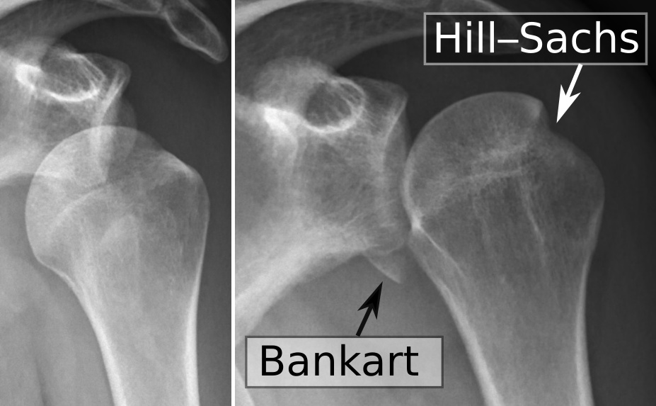 X-ray and diagram of an anterior shoulder dislocation with a Bankart lesion and Hill-Sachs lesion before and after reduction