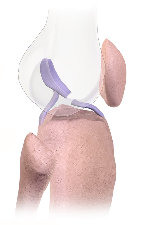 Three-dimensional medical illustration of a torn anterior cruciate ligament in the knee with the femur shown translucent