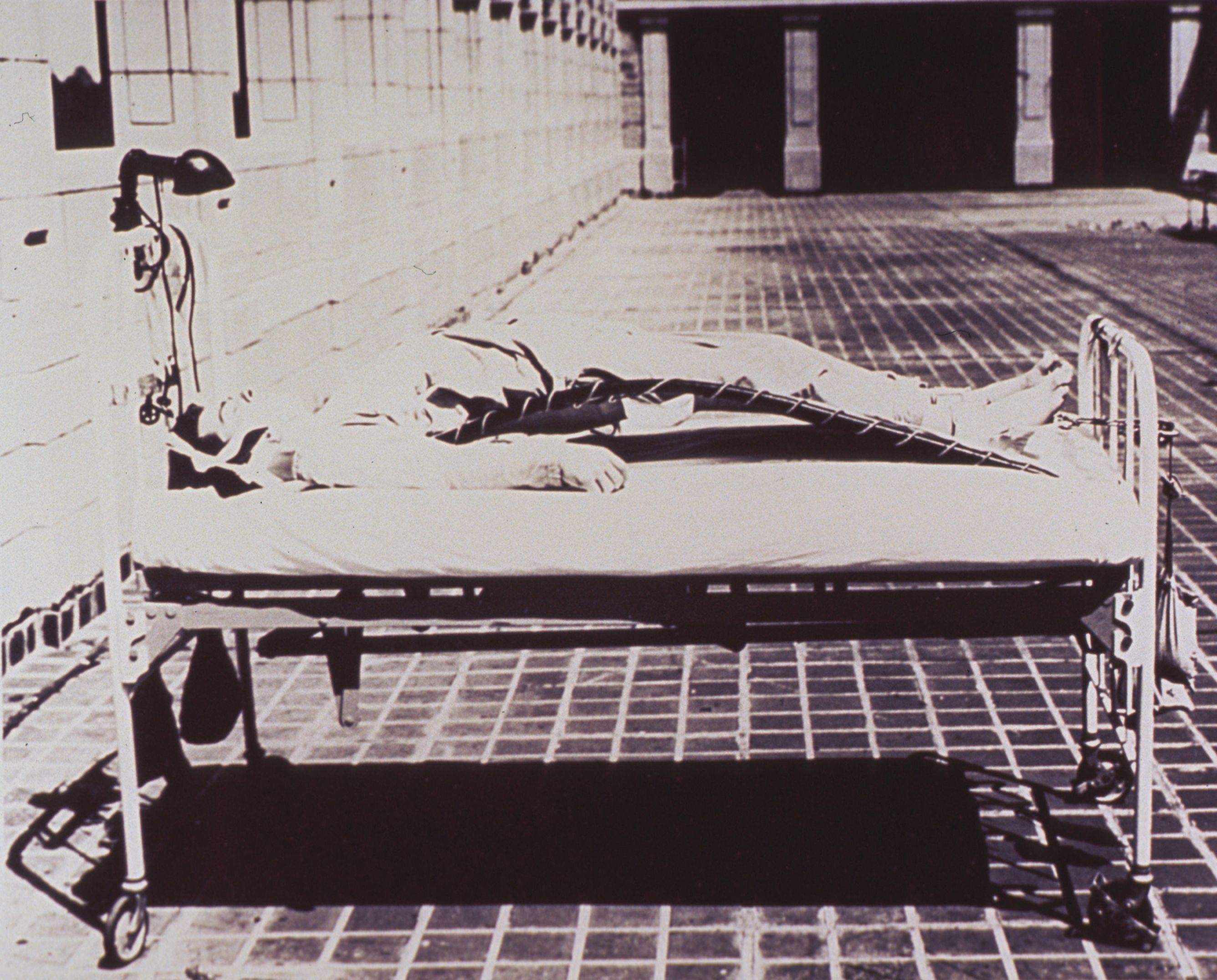 Historical black-and-white photograph of a patient with marked thoracolumbar kyphosis on a traction frame, the stooped posture of advanced spondylitis