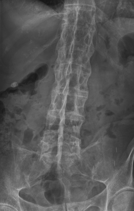 Frontal radiograph of the thoracolumbar spine and pelvis showing bamboo spine with continuous syndesmophytes, the dagger sign, and fused sacroiliac joints