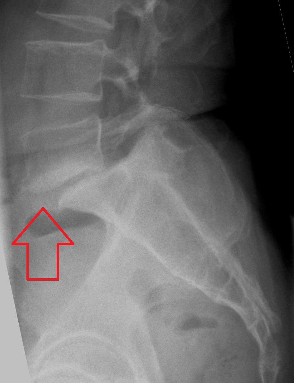 Lateral lumbar radiograph showing L5 anterolisthesis on S1