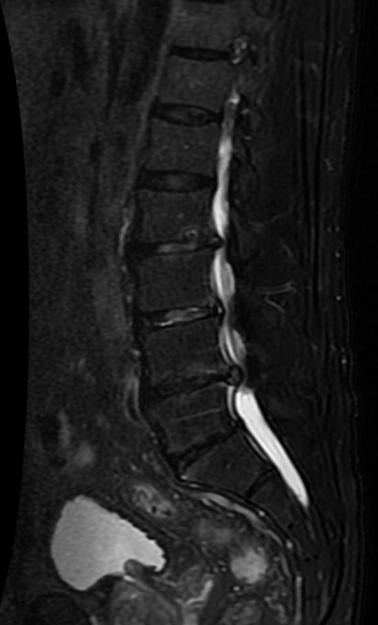 Sagittal lumbar spine MRI showing spinal stenosis from spondylosis