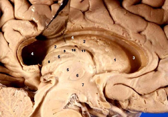 Midsagittal brain showing hypothalamus