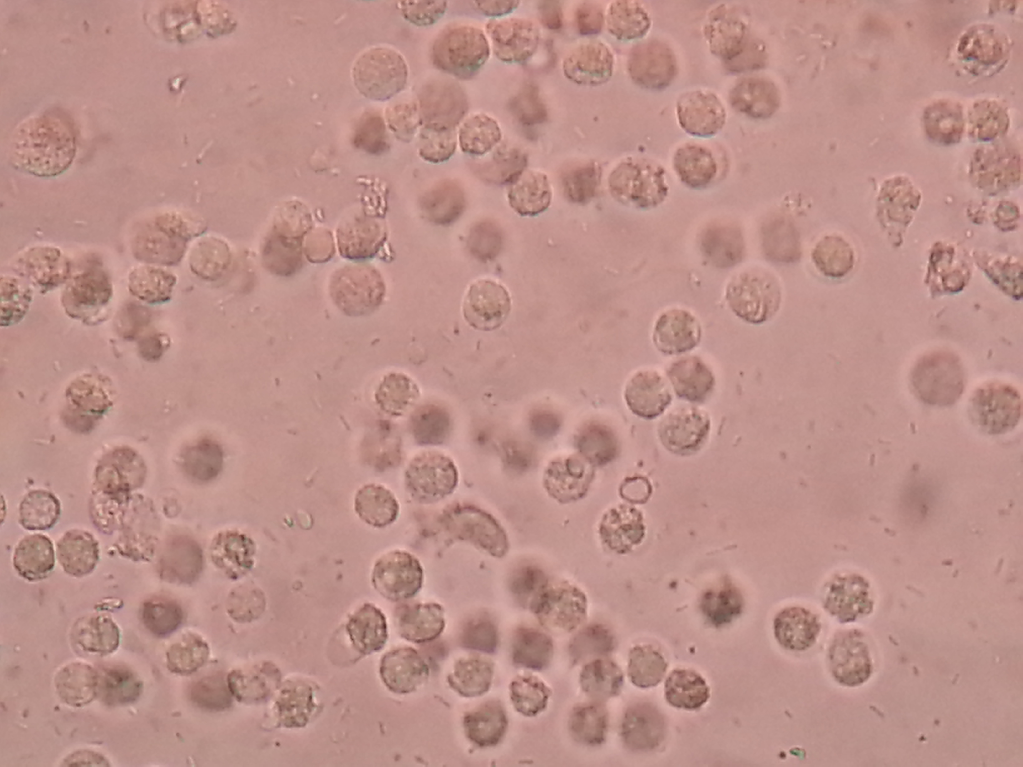 Urine microscopy showing white blood cells