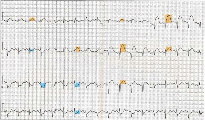 Color-coded ST elevation ECG tracing