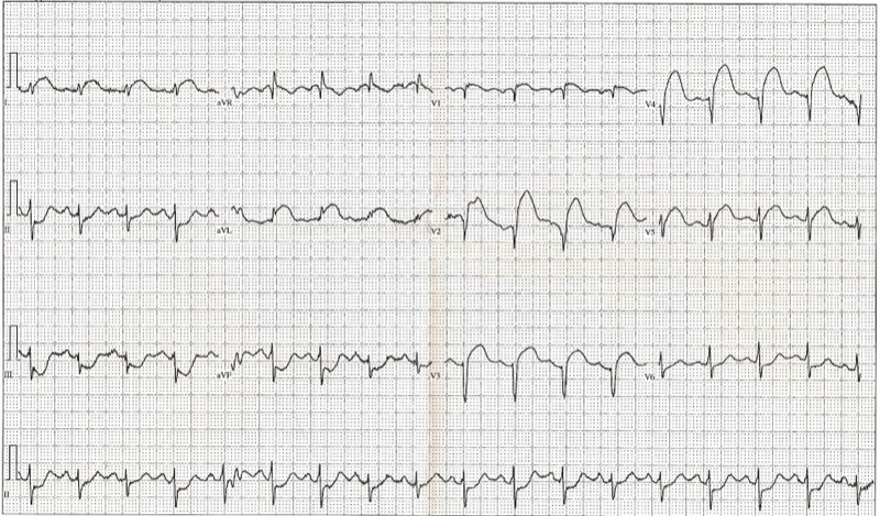 12-lead EKG showing ST elevation in STEMI