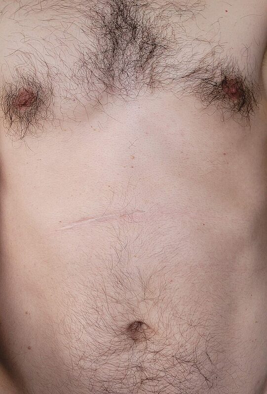 Barium string sign in pyloric stenosis