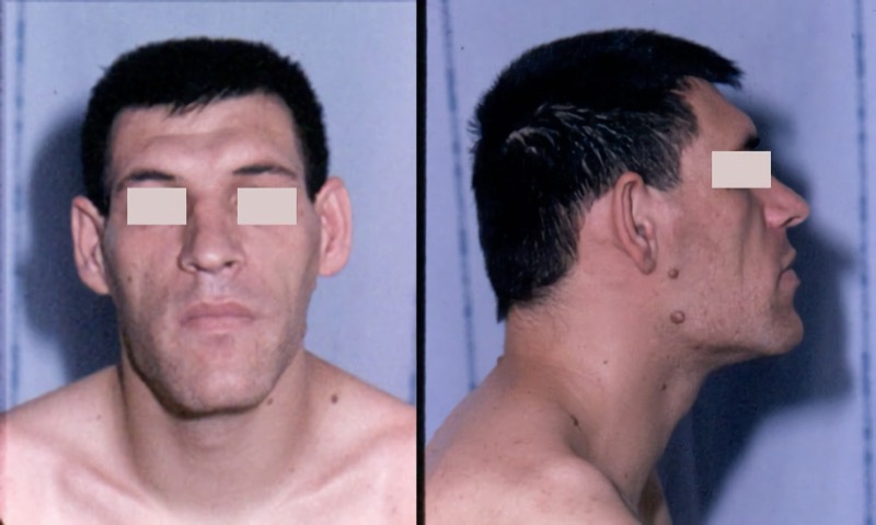 Acromegaly facial features showing coarsened facies
