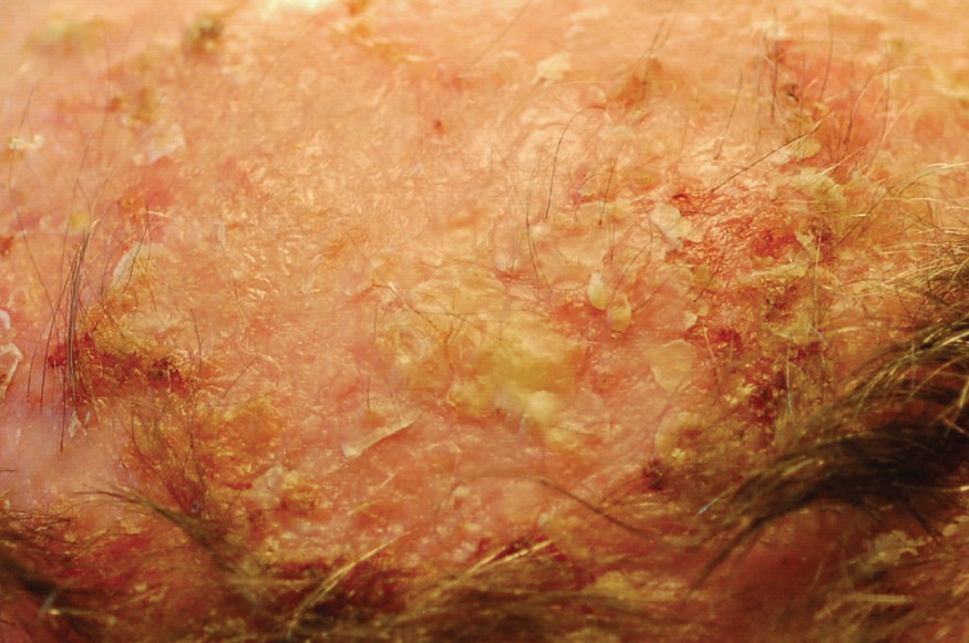 Actinic keratosis on the scalp showing rough scaly patches