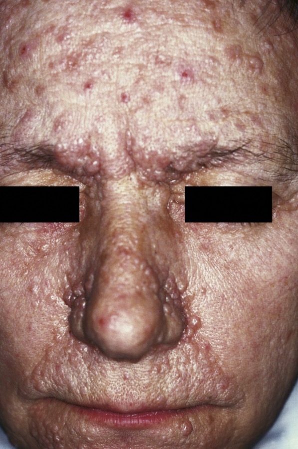 Facial angiofibromas of tuberous sclerosis