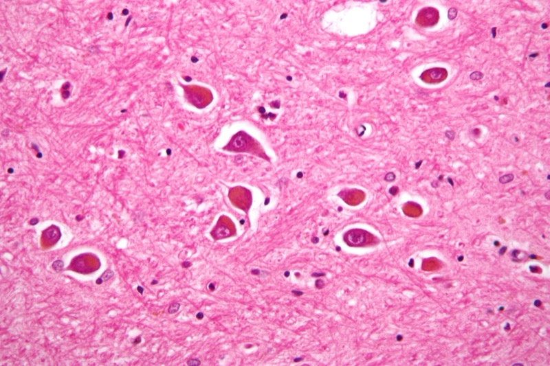 Alzheimer type II astrocyte pathology in hepatic encephalopathy