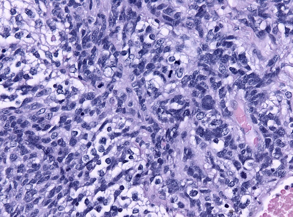 Anaplastic medulloblastoma histology x200: densely packed small blue cells with scant cytoplasm and dark nuclei