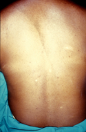 Hypopigmented ash-leaf macules of tuberous sclerosis