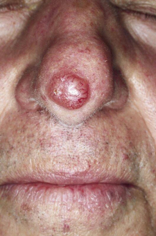 Nodular basal cell carcinoma on nose