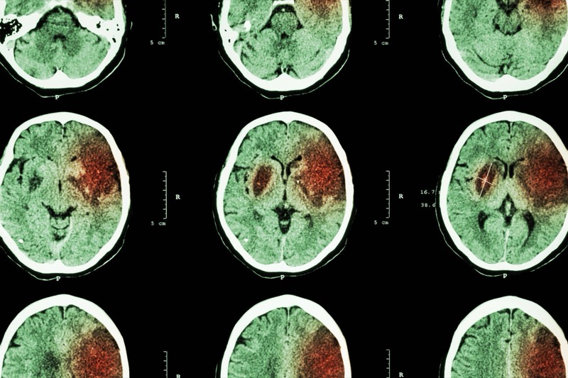 Brain CT for stroke