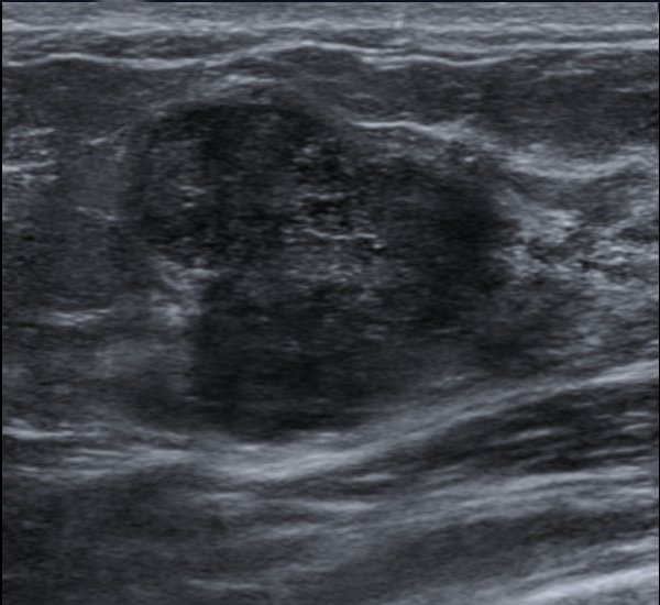 Breast ultrasound showing fibroadenoma