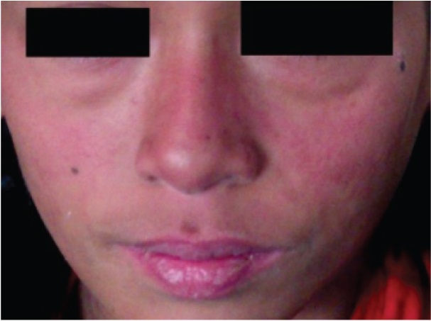Malar butterfly rash of SLE