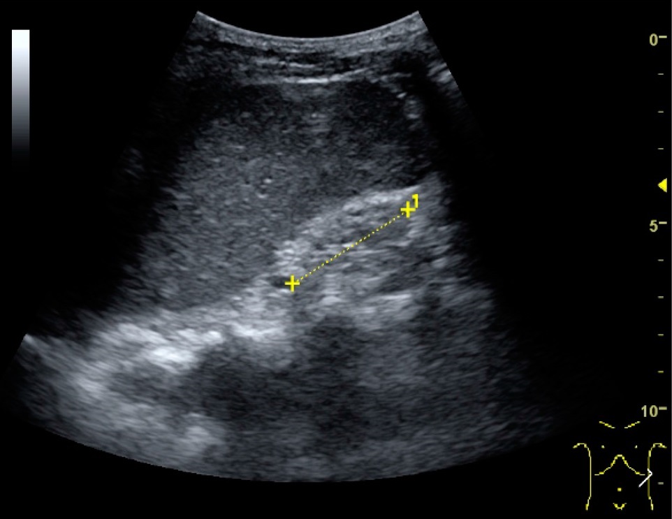 Ultrasound of small echogenic end-stage chronic kidney disease kidney