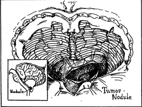 Cerebellar lesion imaging