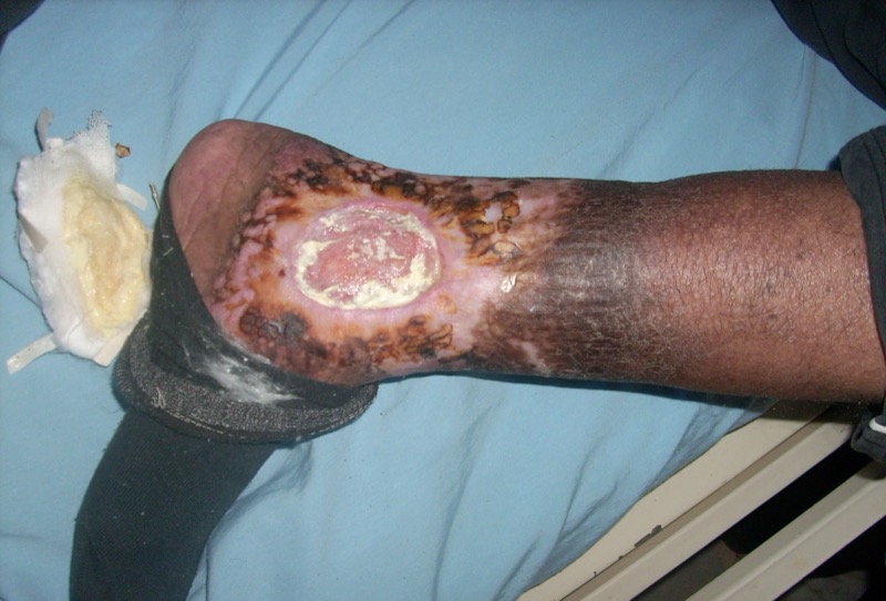 Venous stasis ulcer at medial malleolus