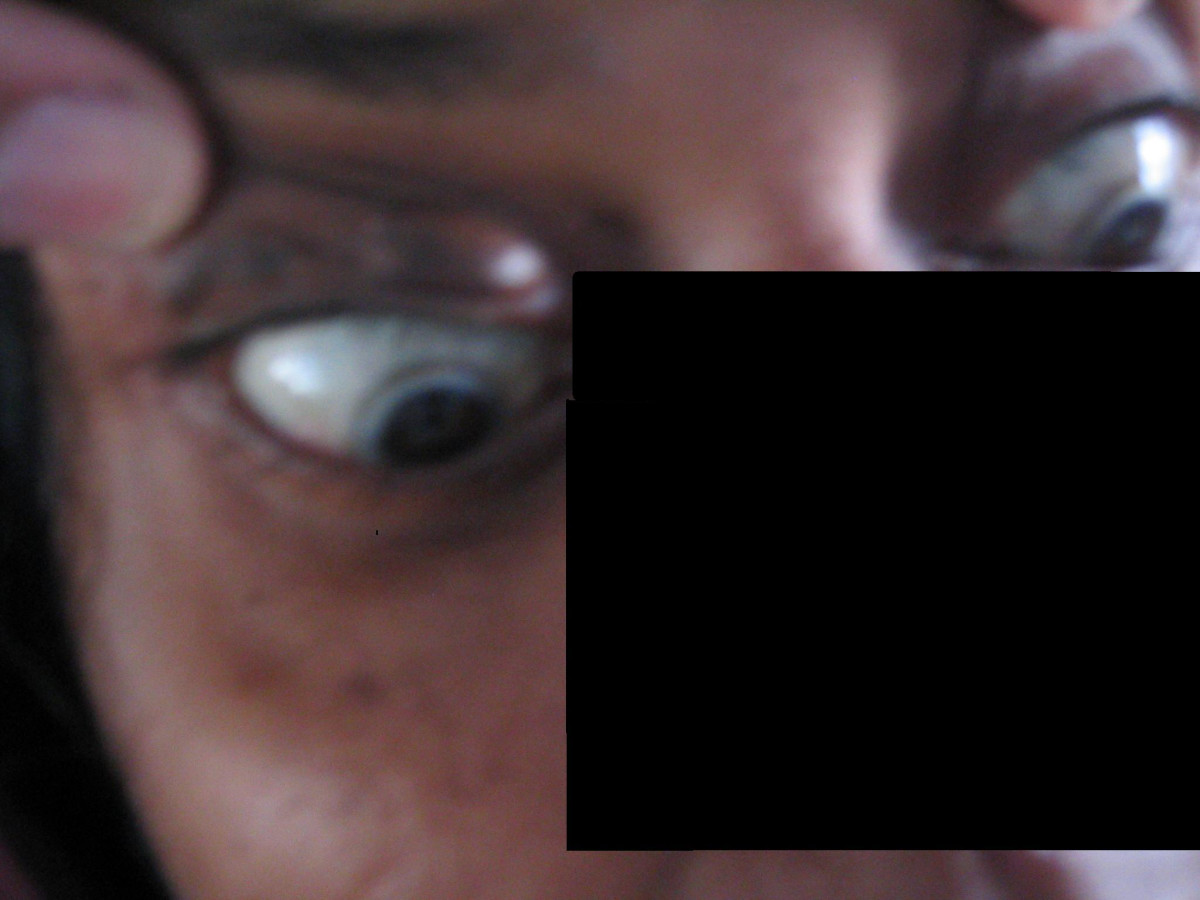 Corneal arcus in young patient