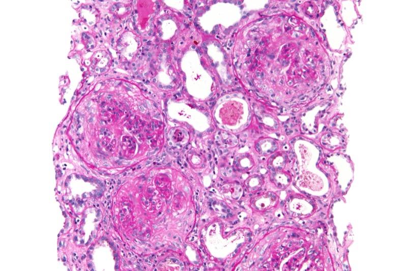 Crescentic glomerulonephritis on biopsy