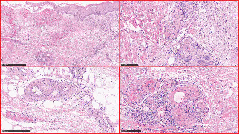 Histopathology of polyarteritis nodosa showing fibrinoid necrosis of a medium-sized artery wall