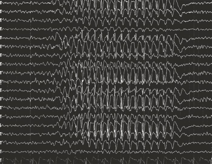 EEG 3Hz spike-and-wave absence seizure