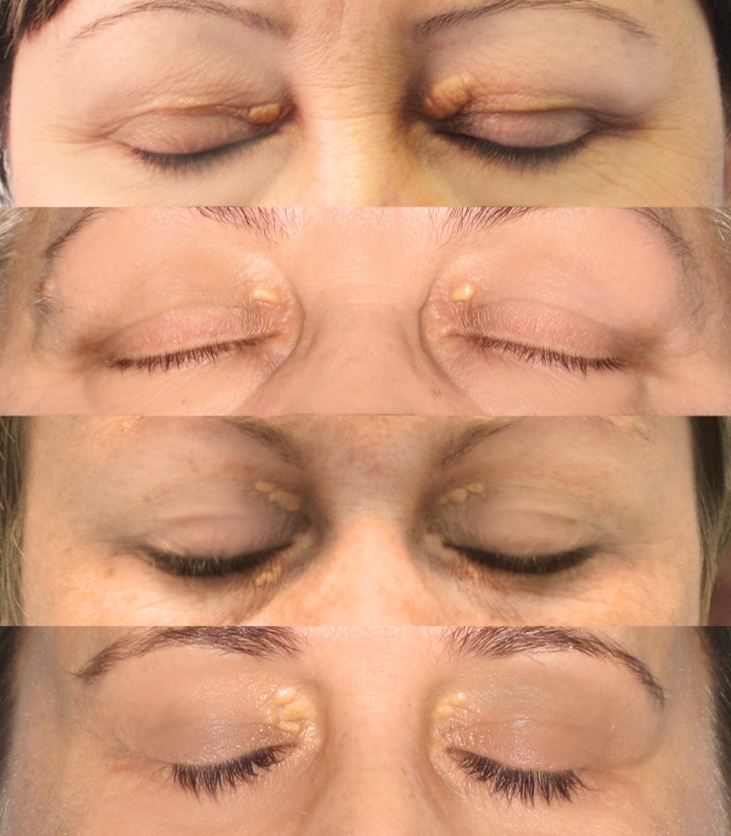 Xanthelasma around eyelids