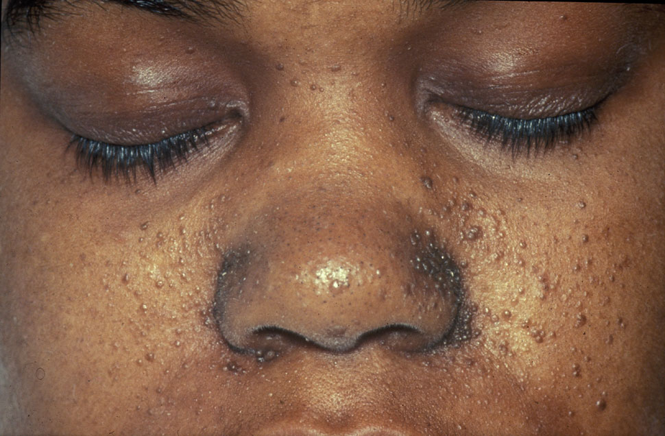 Patient with facial angiofibromas of tuberous sclerosis