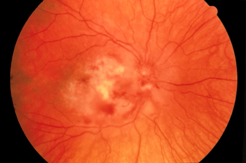 CMV retinitis fundoscopy