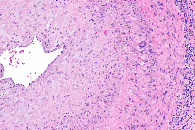 Histology of giant cell arteritis showing granulomatous inflammation with multinucleated giant cells in the arterial wall
