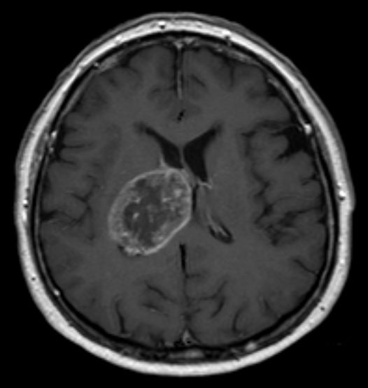 Glioblastoma multiforme on contrast-enhanced MRI