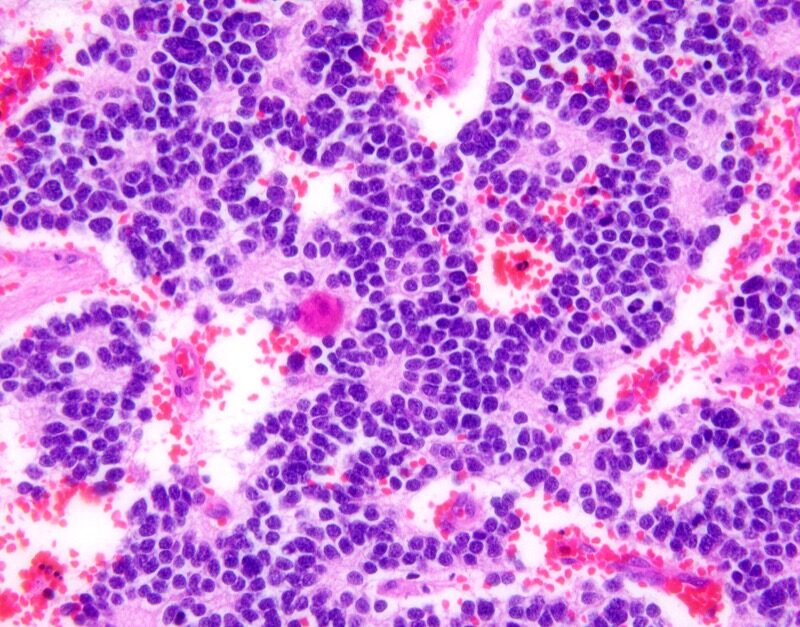 H&E stained neuroblastoma rosettes