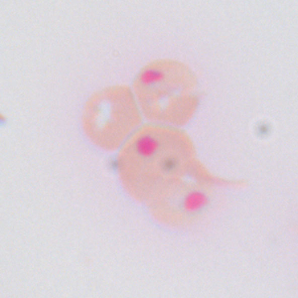 Heinz bodies in red blood cells under supravital staining