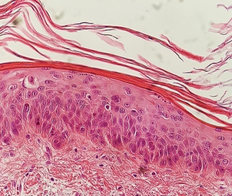 Histopathology of actinic keratosis showing dysplastic keratinocytes