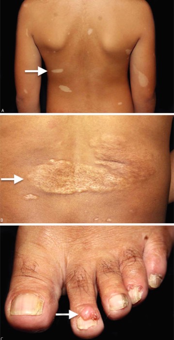 Hypopigmented macules and shagreen patch of tuberous sclerosis