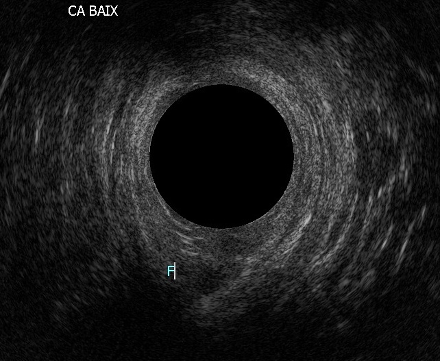 Endoanal ultrasound showing a perianal fistula tract