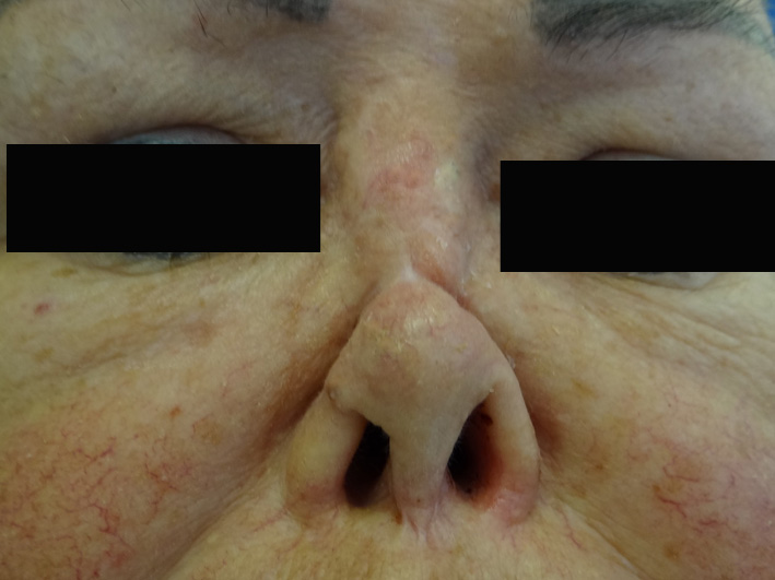 Saddle nose deformity in a patient with granulomatosis with polyangiitis (GPA) due to nasal cartilage destruction