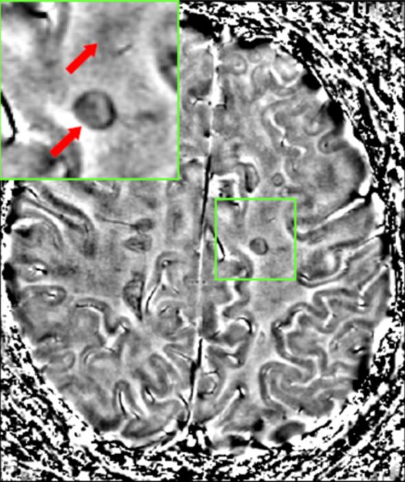 Multiple sclerosis white matter lesions on MRI