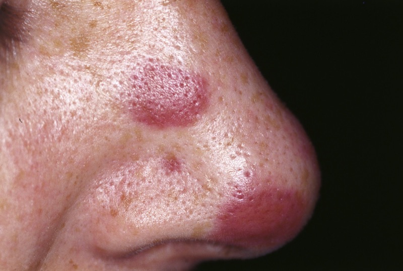 Kaposi sarcoma skin lesions