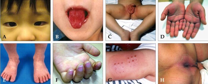 Composite image showing clinical features of Kawasaki disease including conjunctivitis, strawberry tongue, rash, and extremity changes