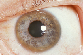 Kayser-Fleischer ring at the corneal periphery in Wilson disease