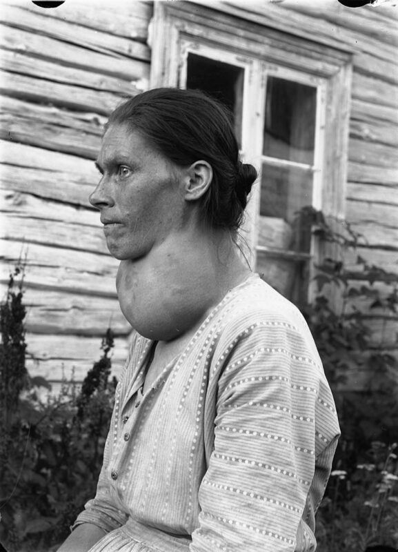 Large goiter on neck
