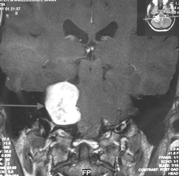 Vestibular schwannoma on MRI
