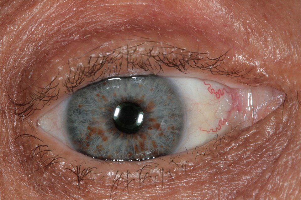 Lisch nodules on the iris of a patient with neurofibromatosis type 1, slit-lamp photograph