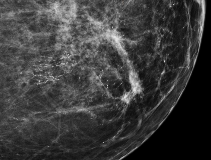 Mammogram showing microcalcifications in DCIS