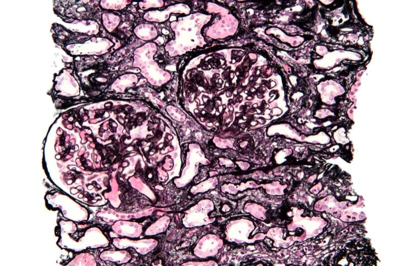 Membranous nephropathy on silver stain showing GBM thickening